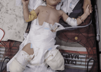Gaza’s vulnerable suffer war’s toll: Malnourished, maimed and displaced