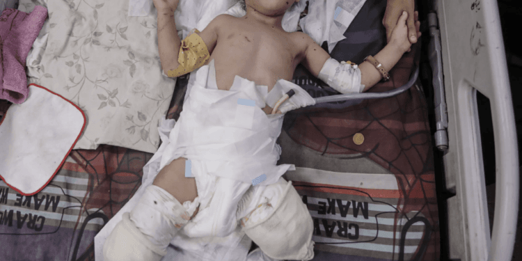 Gaza’s vulnerable suffer war’s toll: Malnourished, maimed and displaced