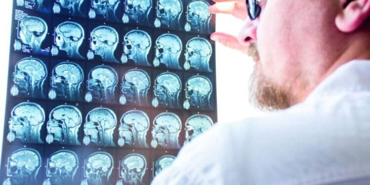 Men three times more likely to die from a brain injury, reveals study