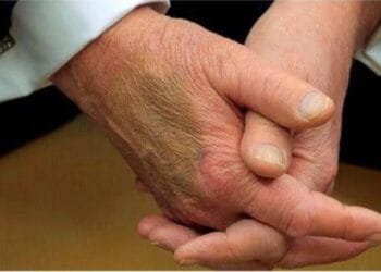 White House reveals secret of the bruise on Trump's hand