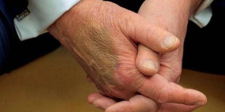 White House reveals secret of the bruise on Trump's hand